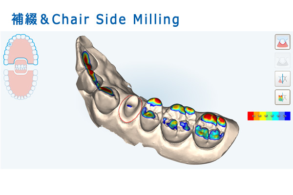 補綴＆Chair Side Milling