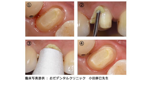 臨床写真：おだデンタルクリニック 小田師巳先生