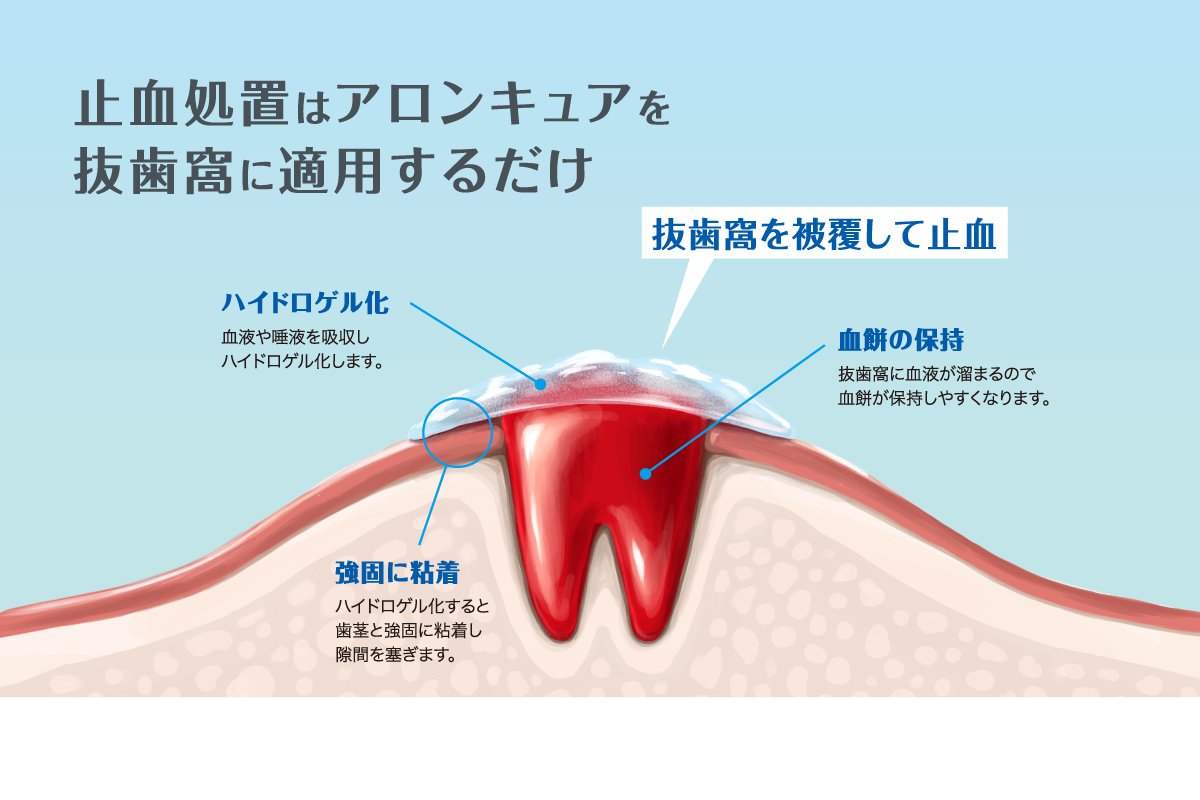 抜歯窩を被覆して止血